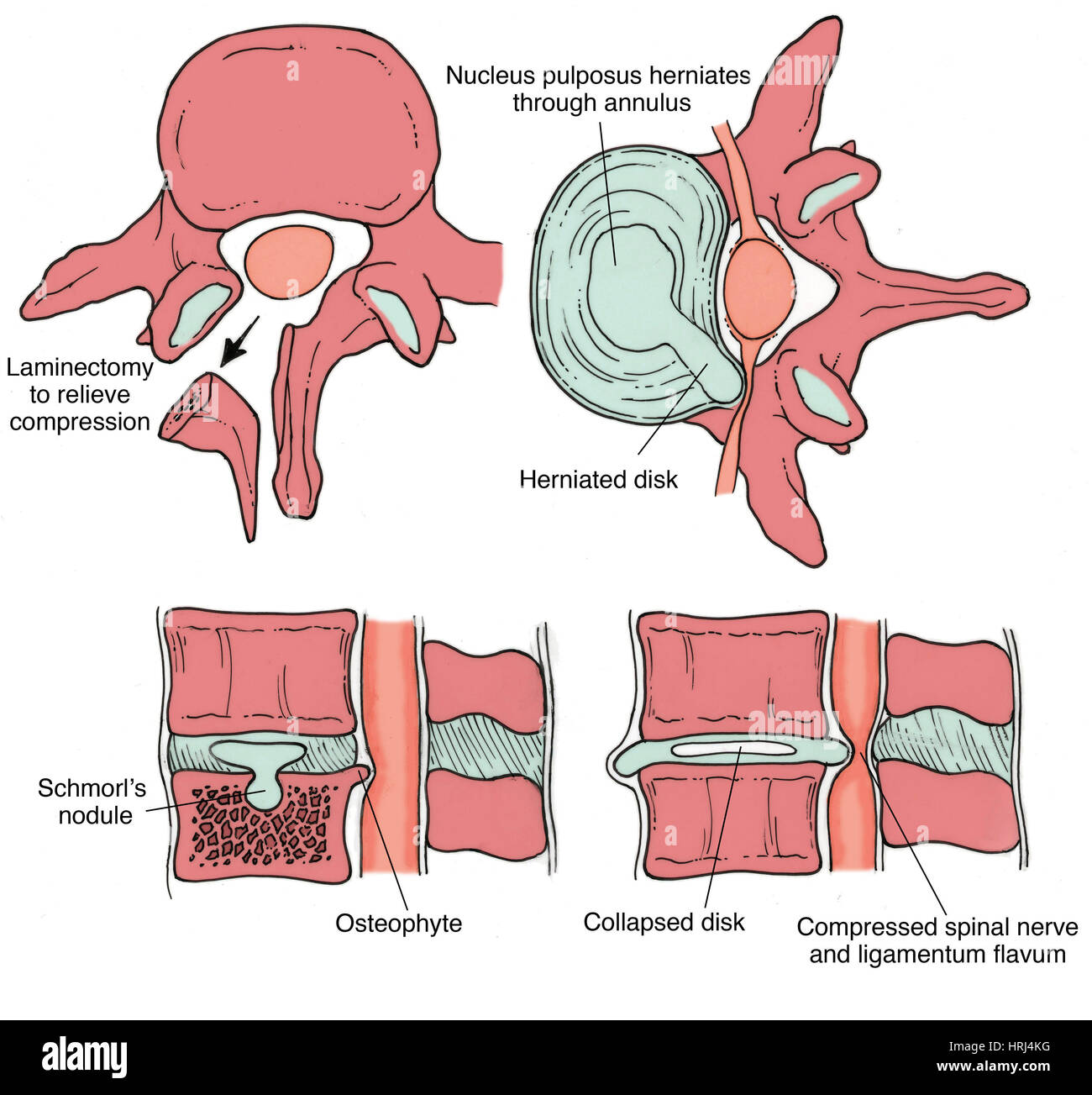 Illustration der spinalen Scheibe Pathologien Stockfoto