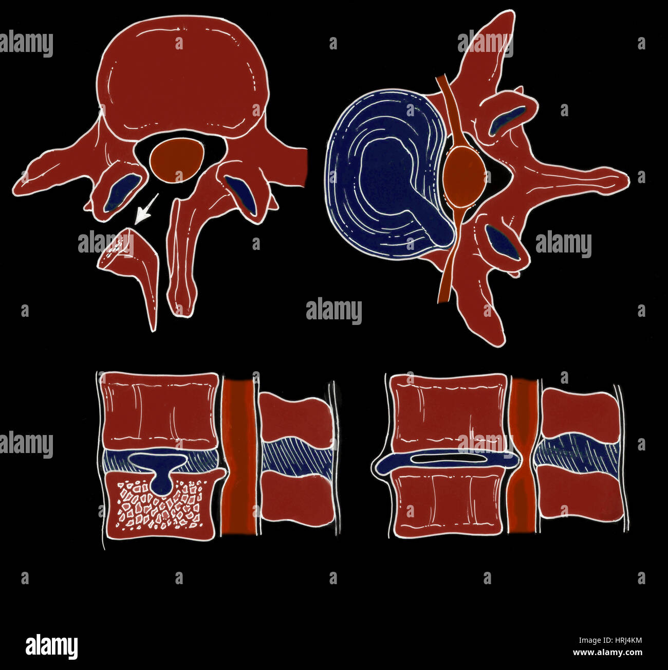 Illustration der spinalen Scheibe Pathologien Stockfoto