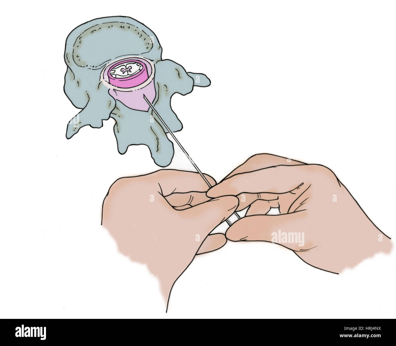 Illustration der Lumbalpunktion (Lumbalpunktion) Stockfoto