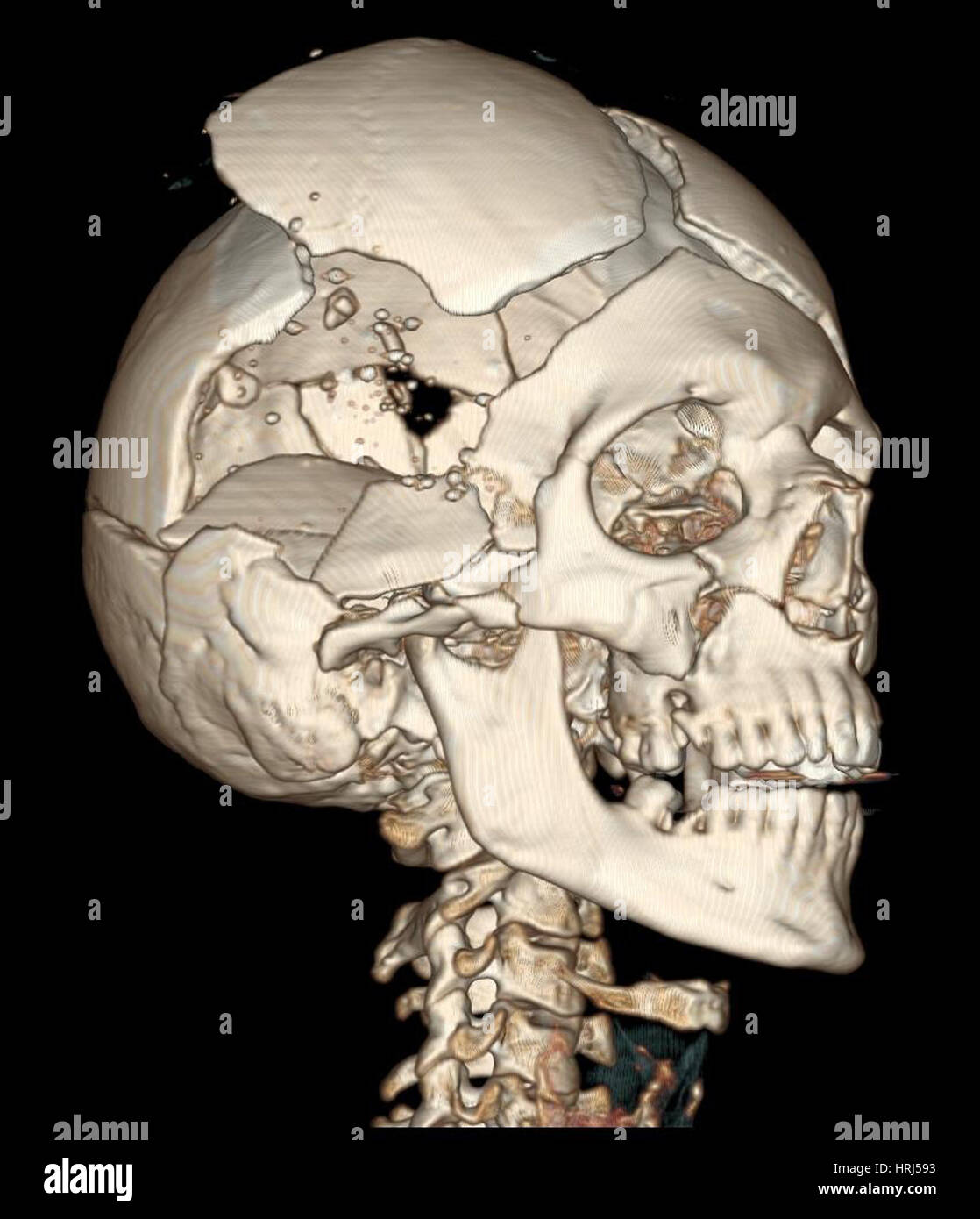 Dreidimensionale CT-Rekonstruktion, Schädel mit Schussverletzungen Stockfoto