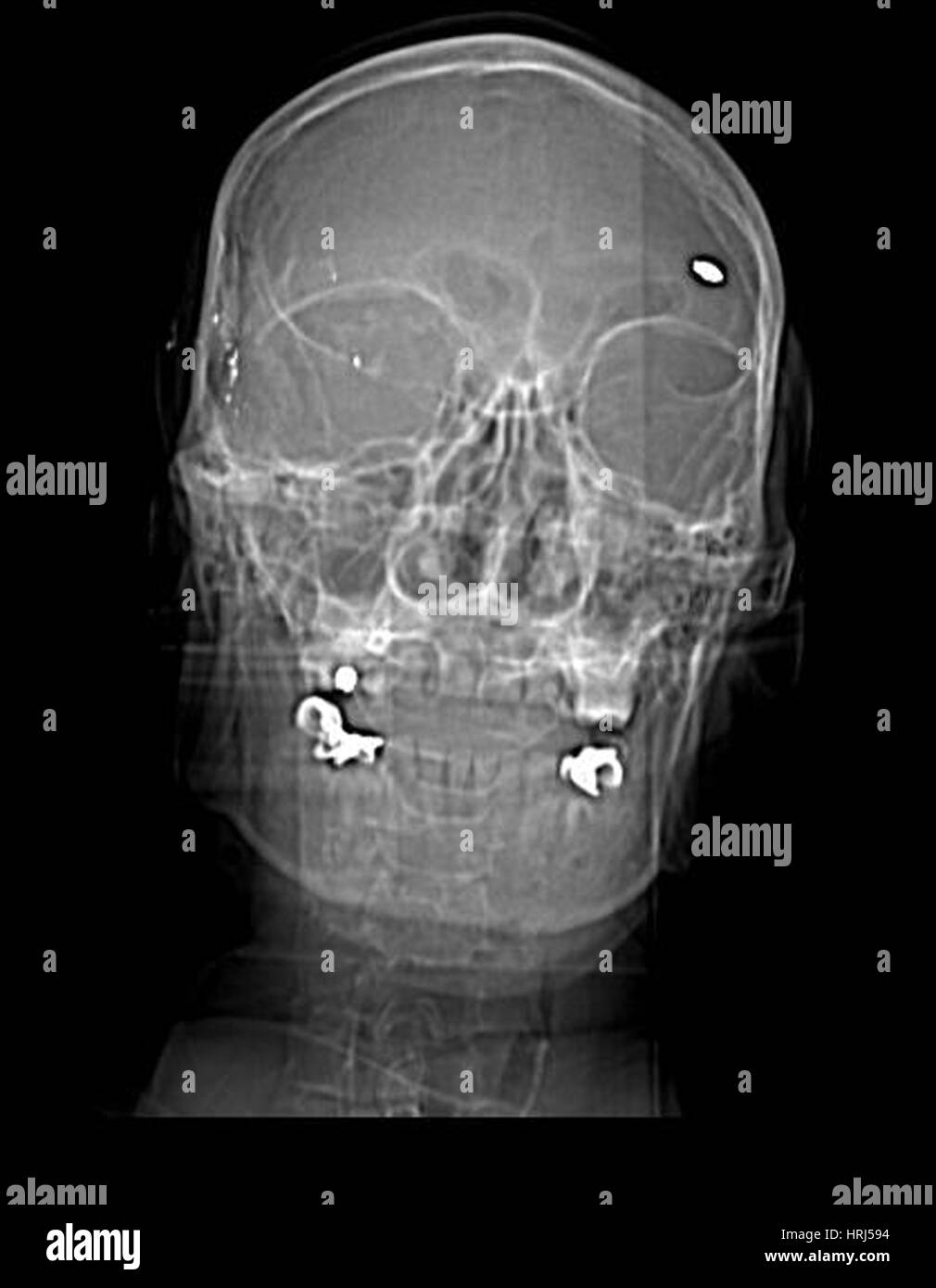 Scouter View CT Scout View, Kugel-Fragmente Stockfotografie - Alamy