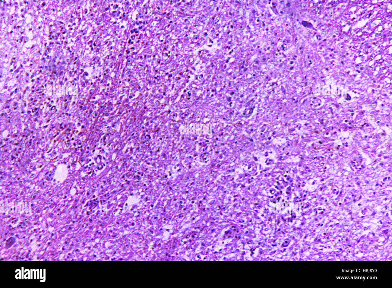 Typ 3 Poliomyelitis, zervikalen Rückenmark, LM Stockfoto