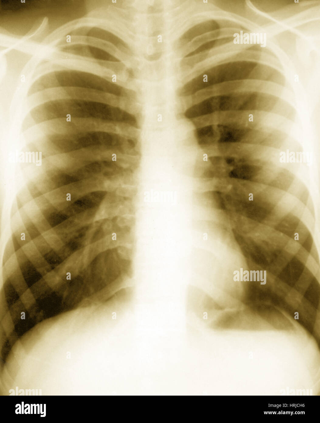 Herz und Lunge, x-ray Stockfoto