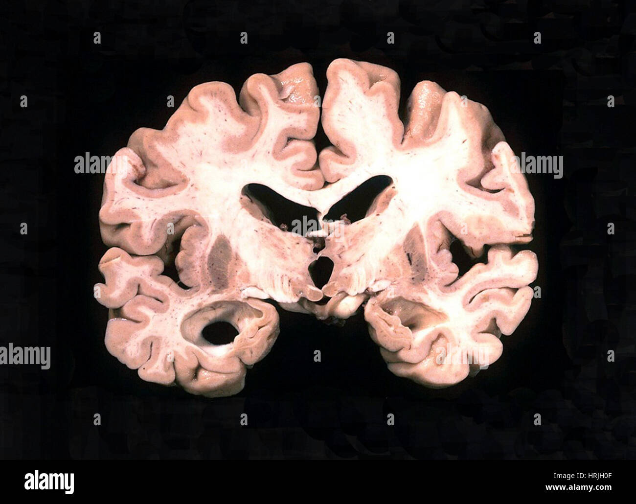 Alzheimer-Gehirn, Brutto-Probe Stockfoto