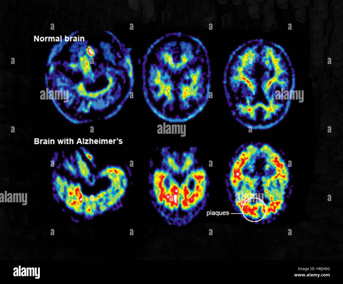 Normal und Alzheimer Gehirn, PET-Scans Stockfoto