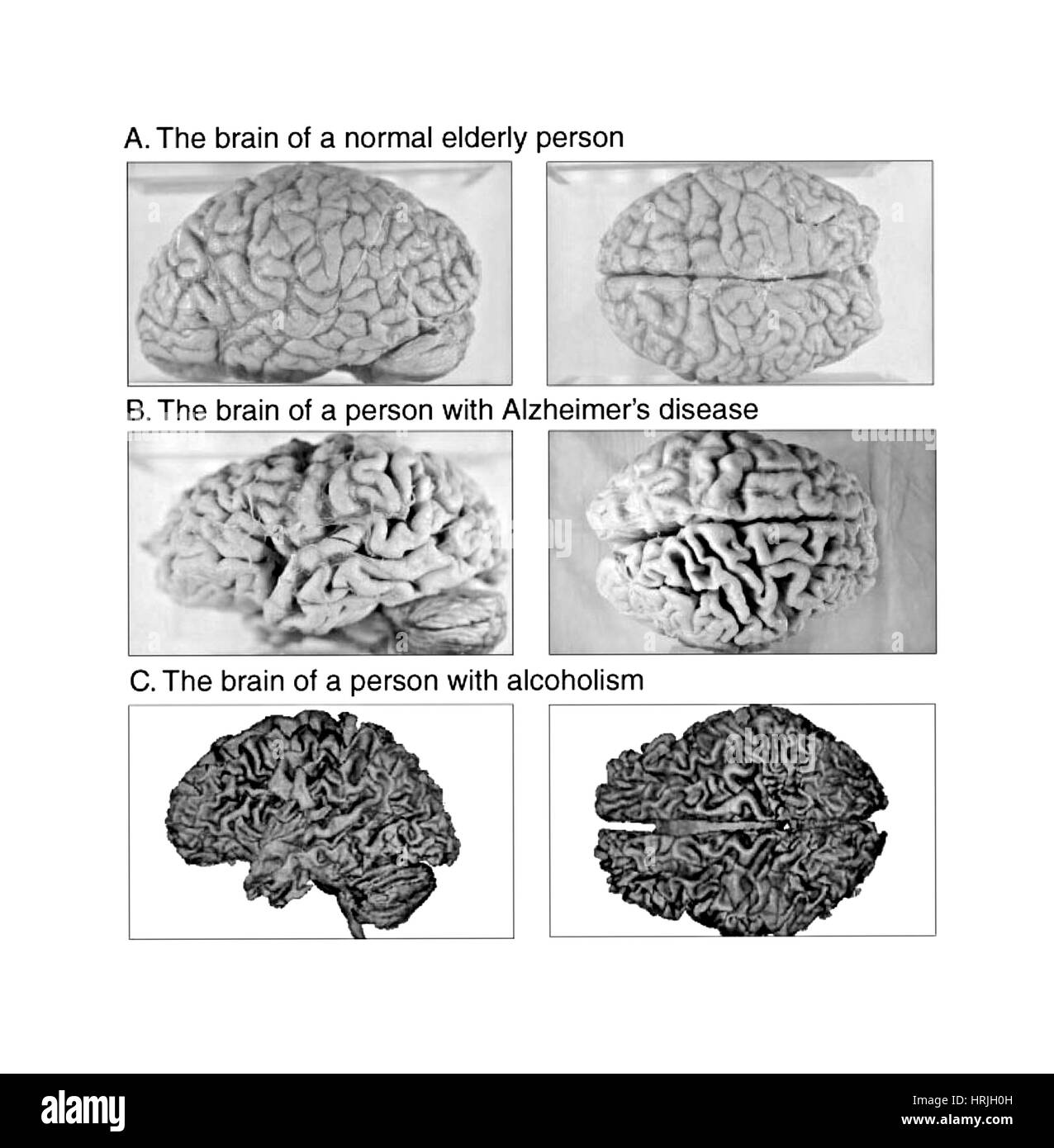 Normal, Alzheimer und alkoholische Gehirn Exemplare Stockfoto
