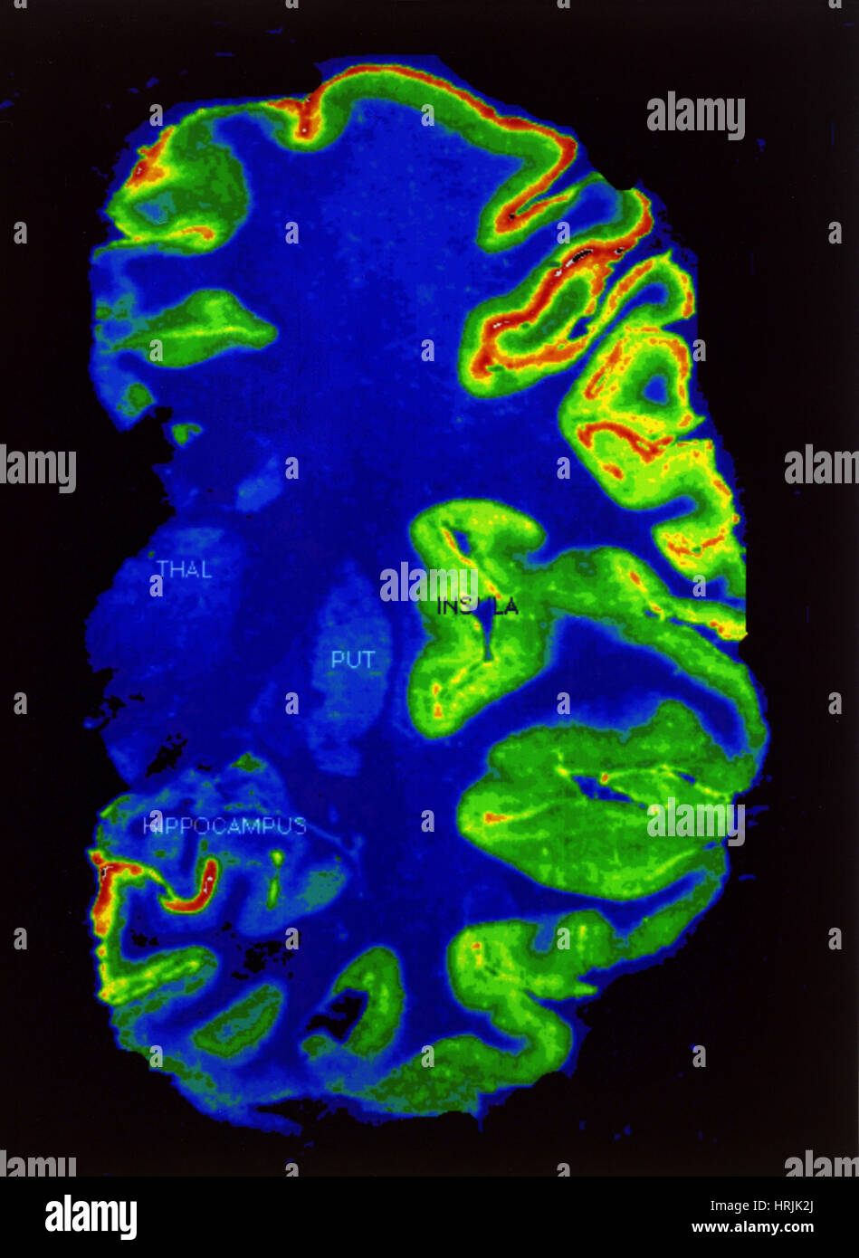 PET-Scan, gesundes Gehirn Stockfoto