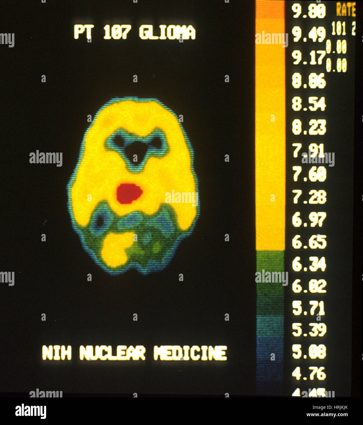 Bösartigen Hirntumor, PET-Scan Stockfoto