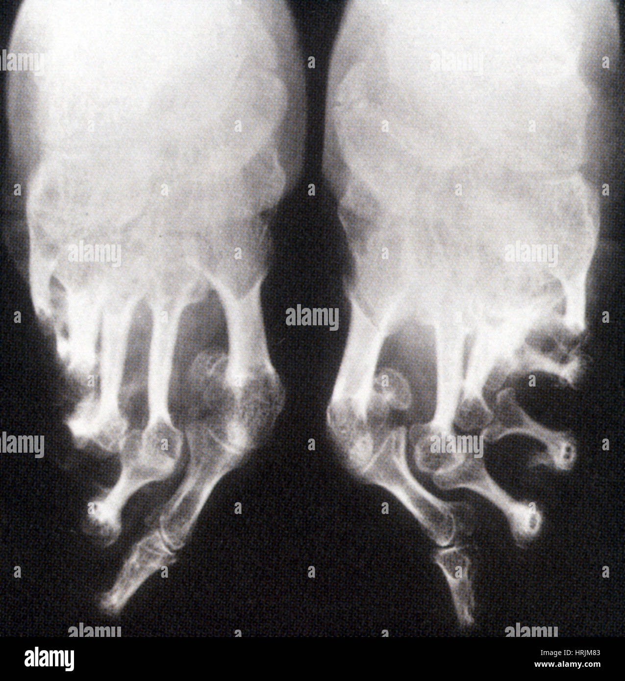 Gebunden Füße, x-ray Stockfoto