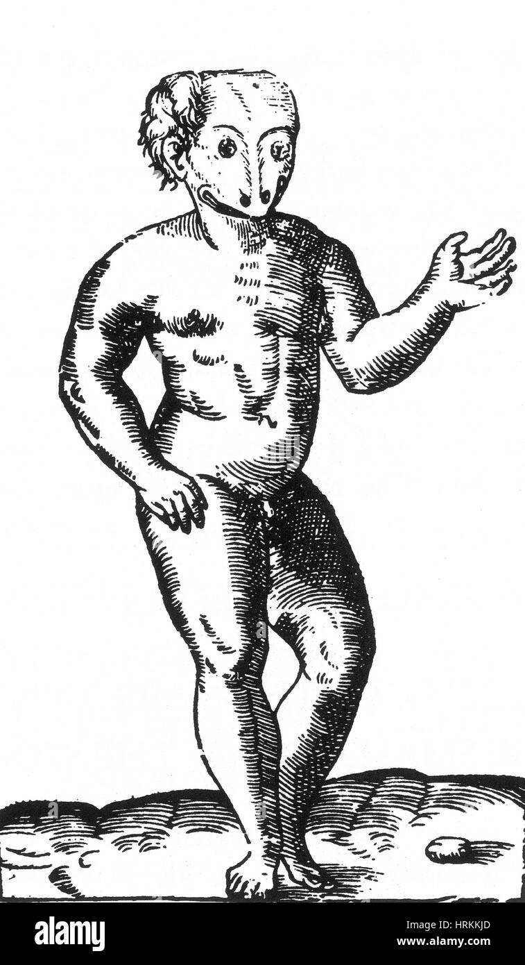Anencephale Kind, 16. Jahrhundert Stockfoto