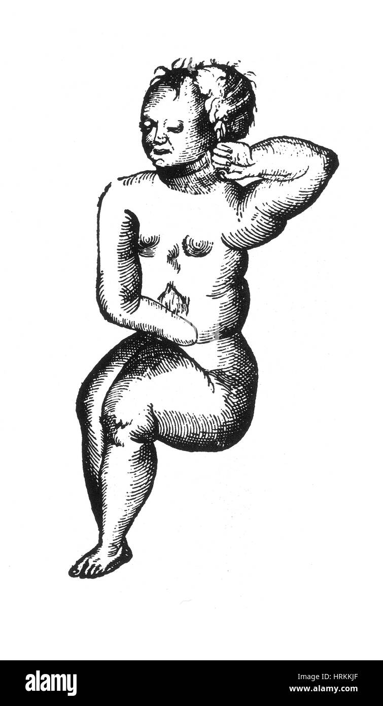 Lithopaedion, Stein Baby, 16. Jahrhundert Stockfoto