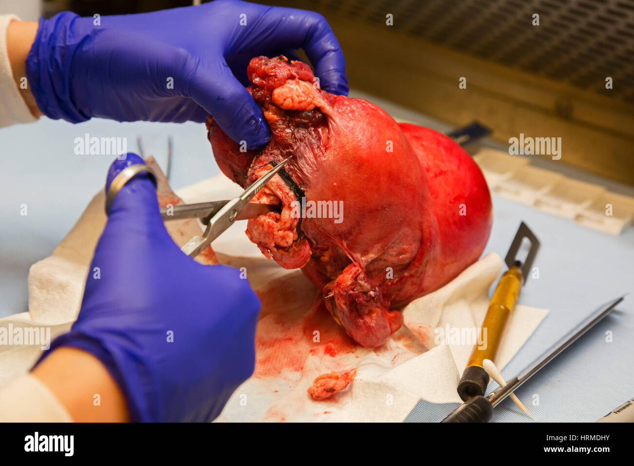 Detroit, Michigan - ein Pathologie-Assistentin am Detroit Medical Center untersucht eine Gebärmutter mit endometrialen Adenokarzinom. Stockfoto