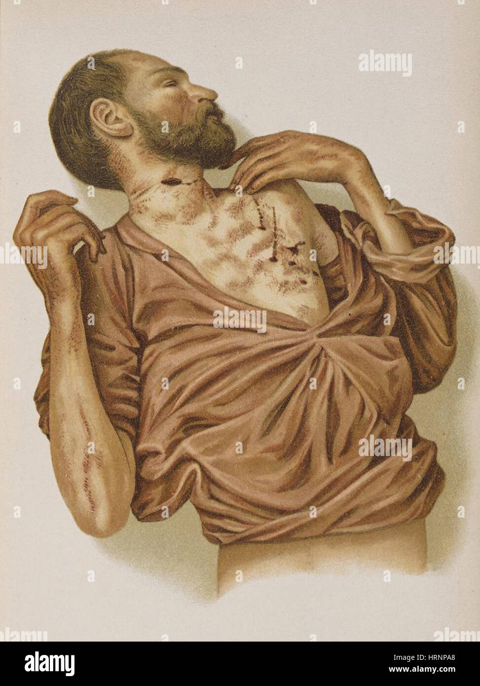 Selbstmord durch stechende, 1898 Stockfoto