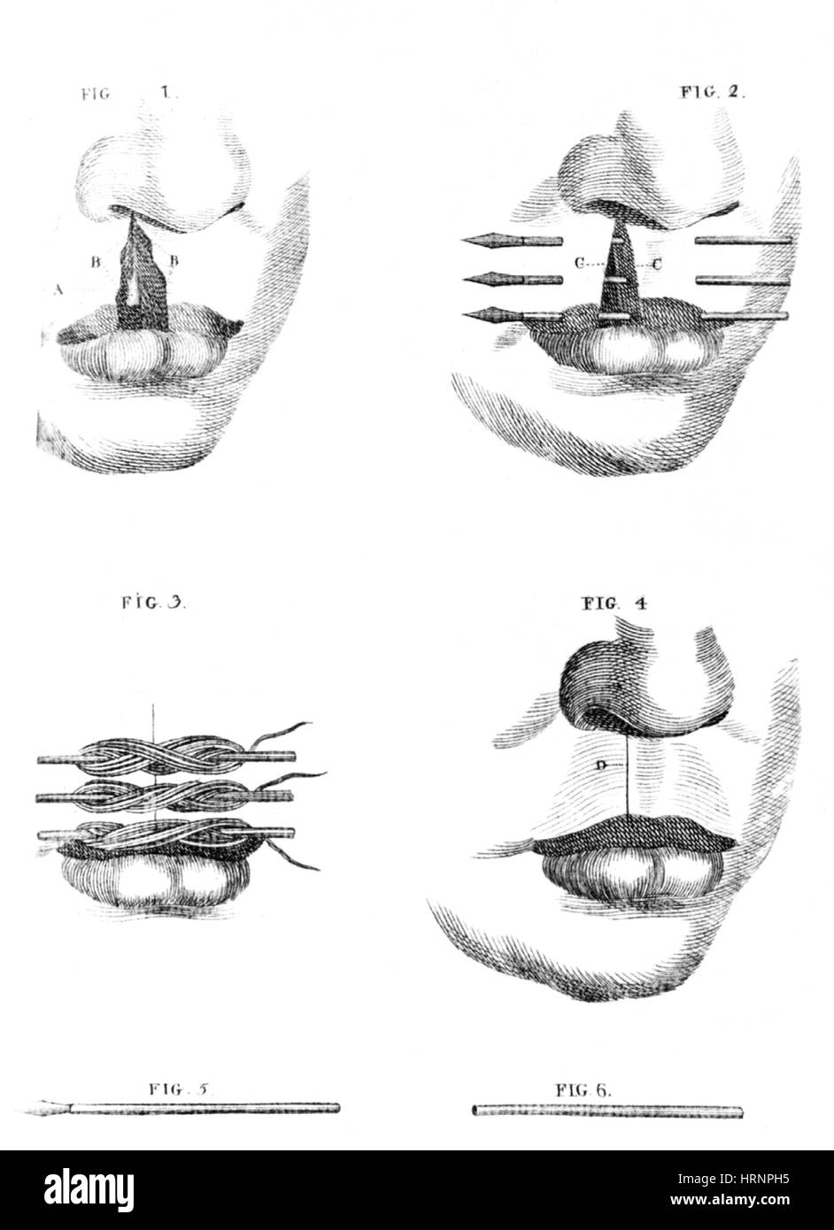 Lippen-Kiefer-Chirurgie, 1791 Stockfoto