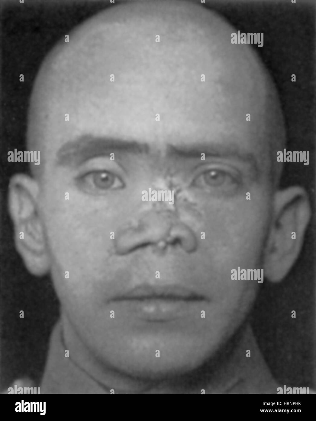 WWI Veteran müssen rekonstruktive Chirurgie Stockfoto