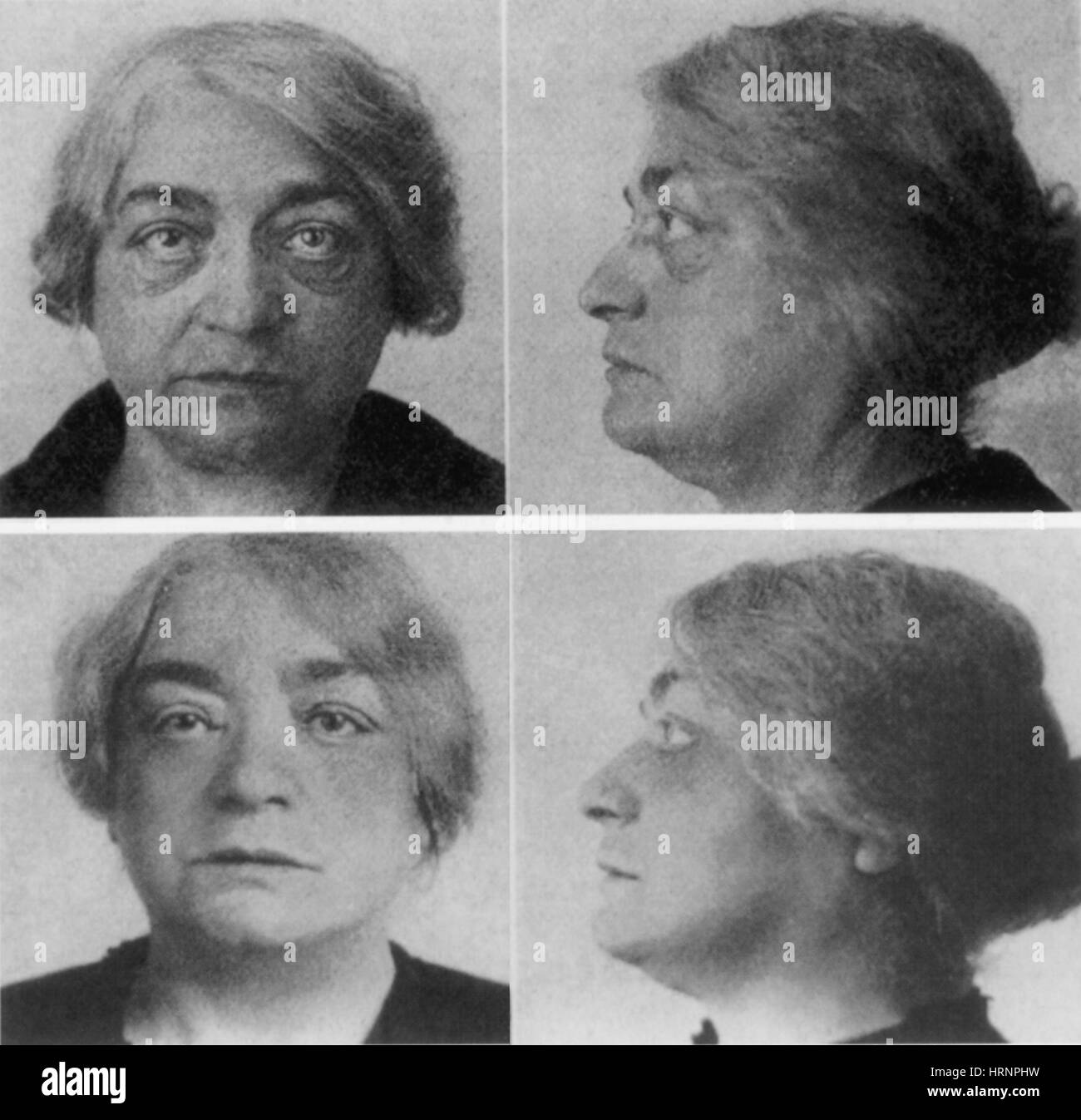 Einer der ersten Facelifts von weiblichen Chirurgen, Suzanne Noel Stockfoto