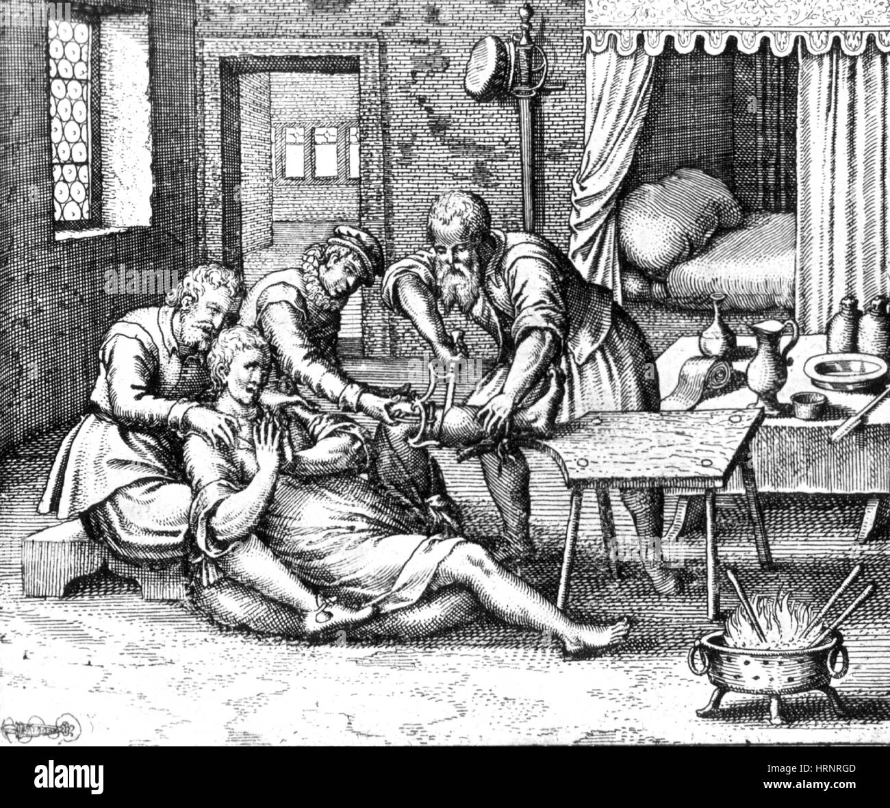 Gangrän Amputation des Beins, 17. Jahrhundert Stockfoto