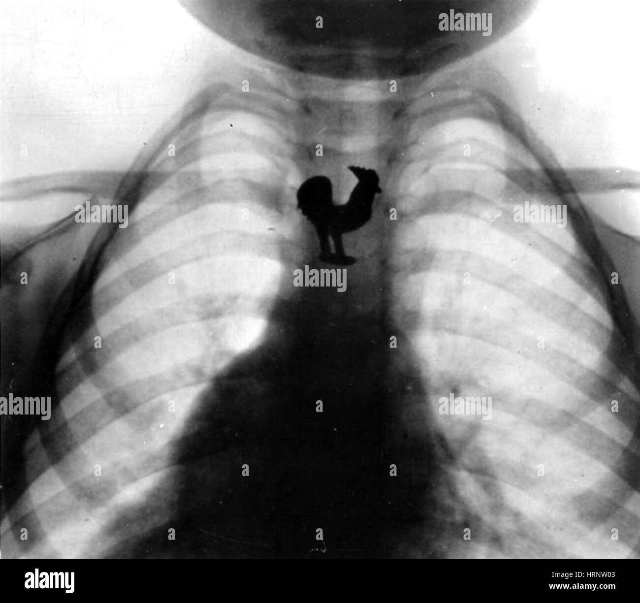 X-ray Schmuckstück verschluckt von Kind, 1933 Stockfoto