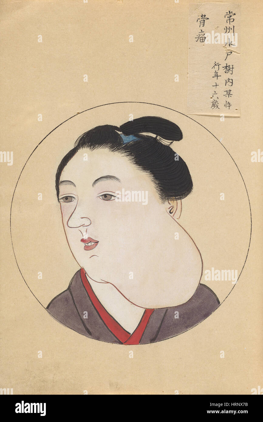 Tumor des Kiefers, "Chirurgische Casebook" Stockfoto