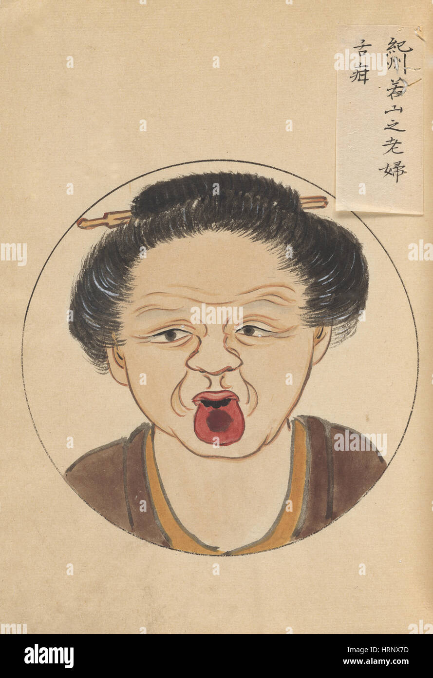 Zungenkrebs, "Chirurgische Casebook" Stockfoto