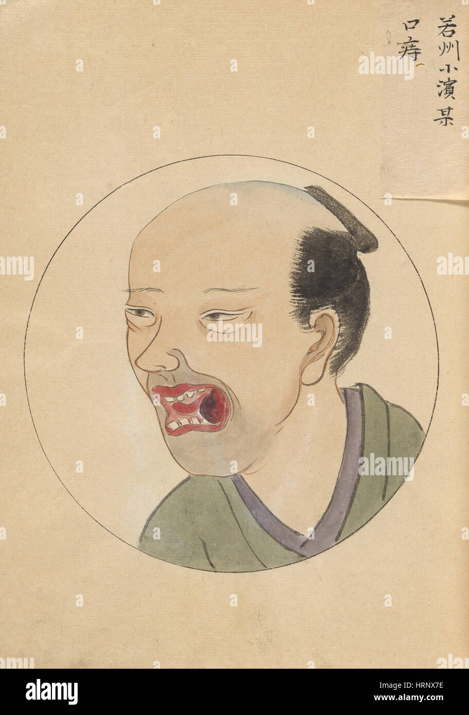 Mundkrebs, "Chirurgische Casebook" Stockfoto