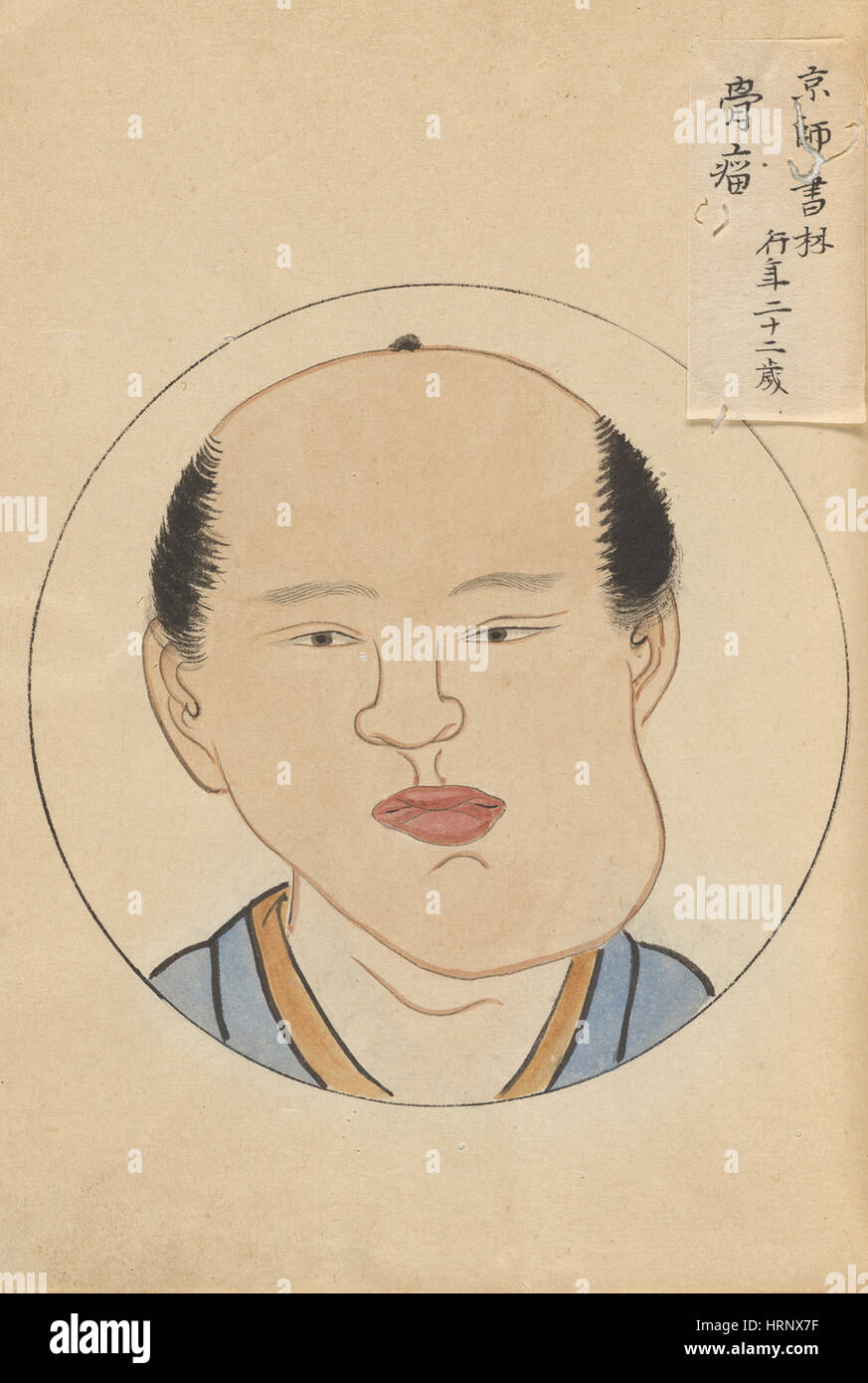 Tumor des Kiefers, 1 von 2 Stockfoto