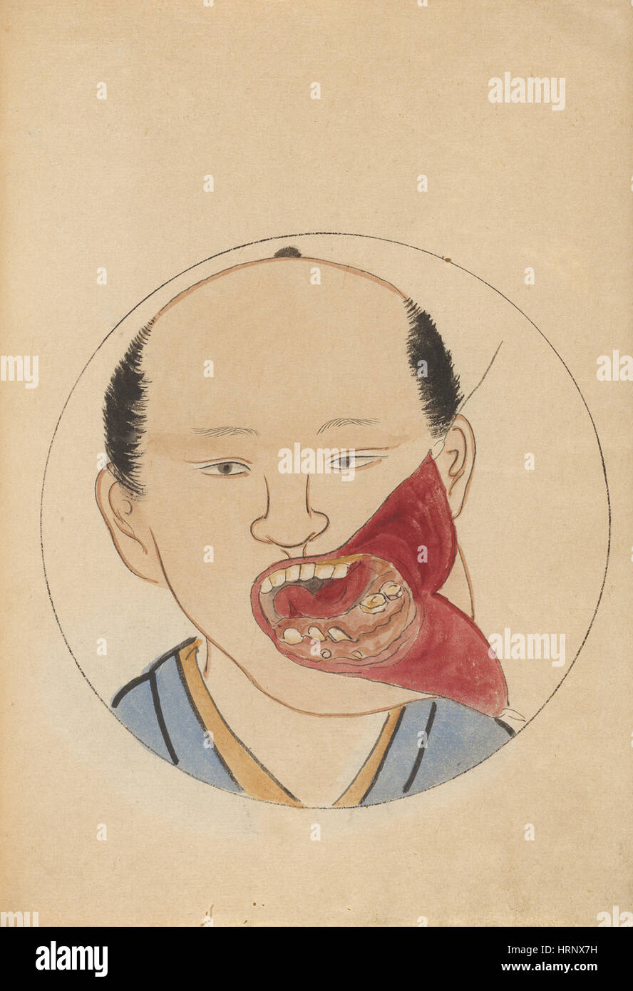 Tumor des Kiefers, 2 von 2 Stockfoto