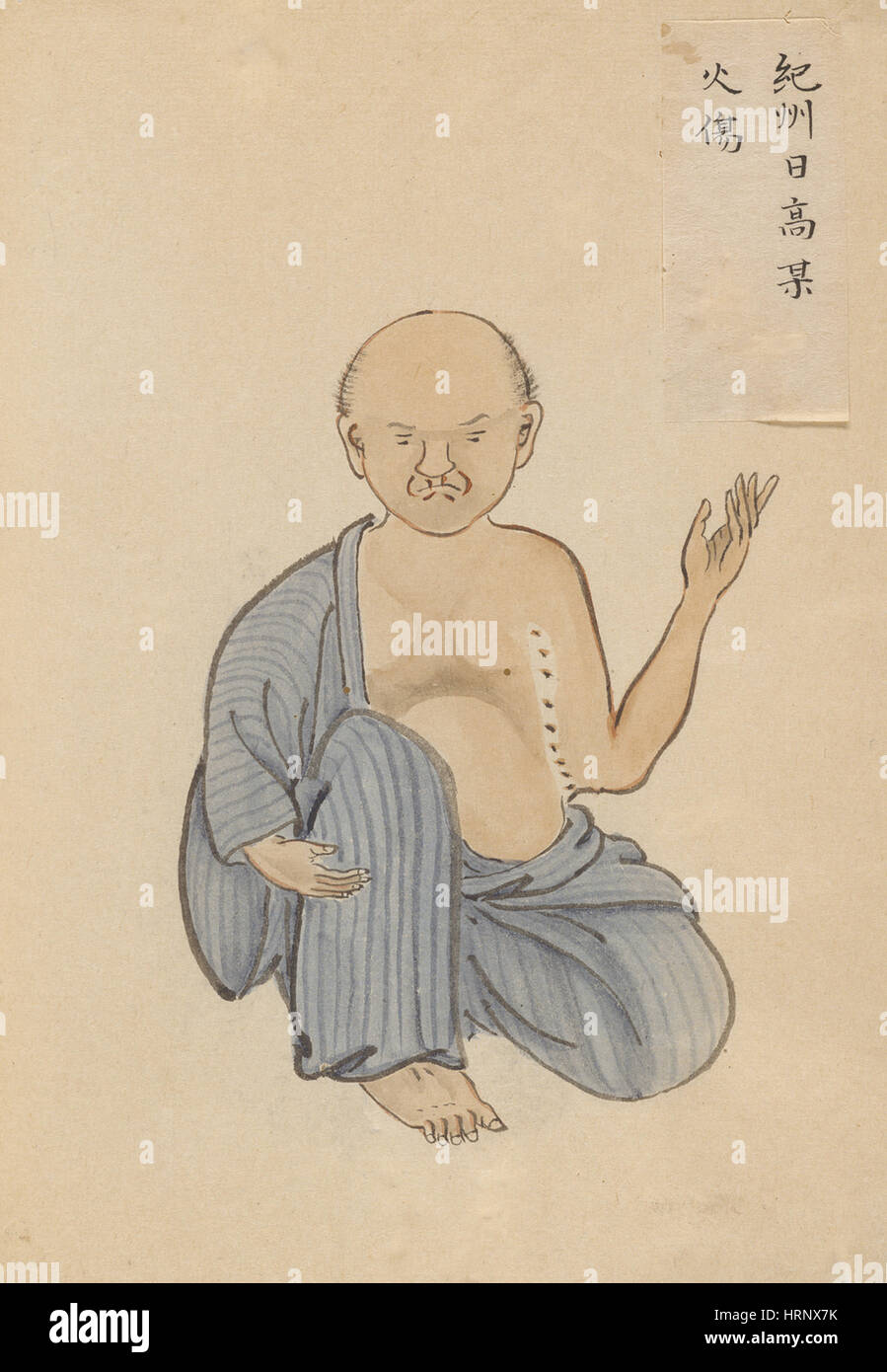 Narbe Kontraktur vor der Operation, 1 von 2 Stockfoto