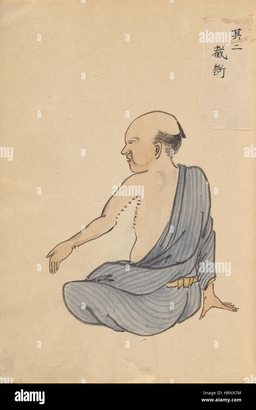 Kontraktur der Narbe nach der Operation, 2 von 2 Stockfoto