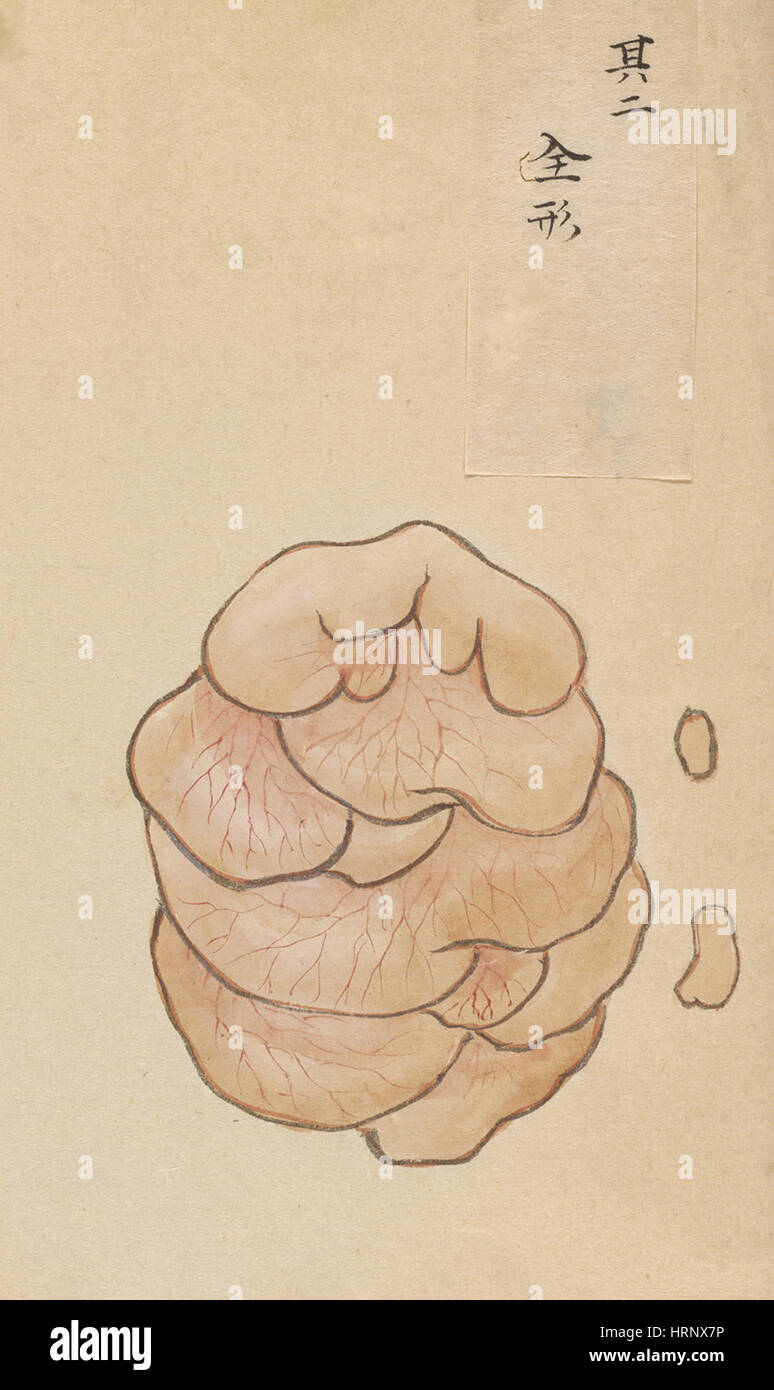 Tumor entfernt von hinten, 2 von 2 Stockfoto