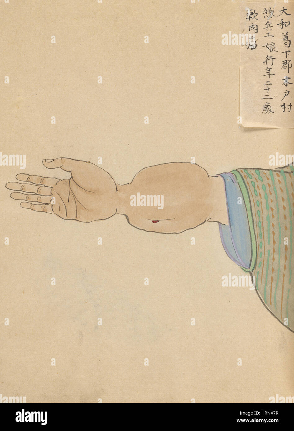 Weichteiltumor, "Chirurgische Casebook" Stockfoto