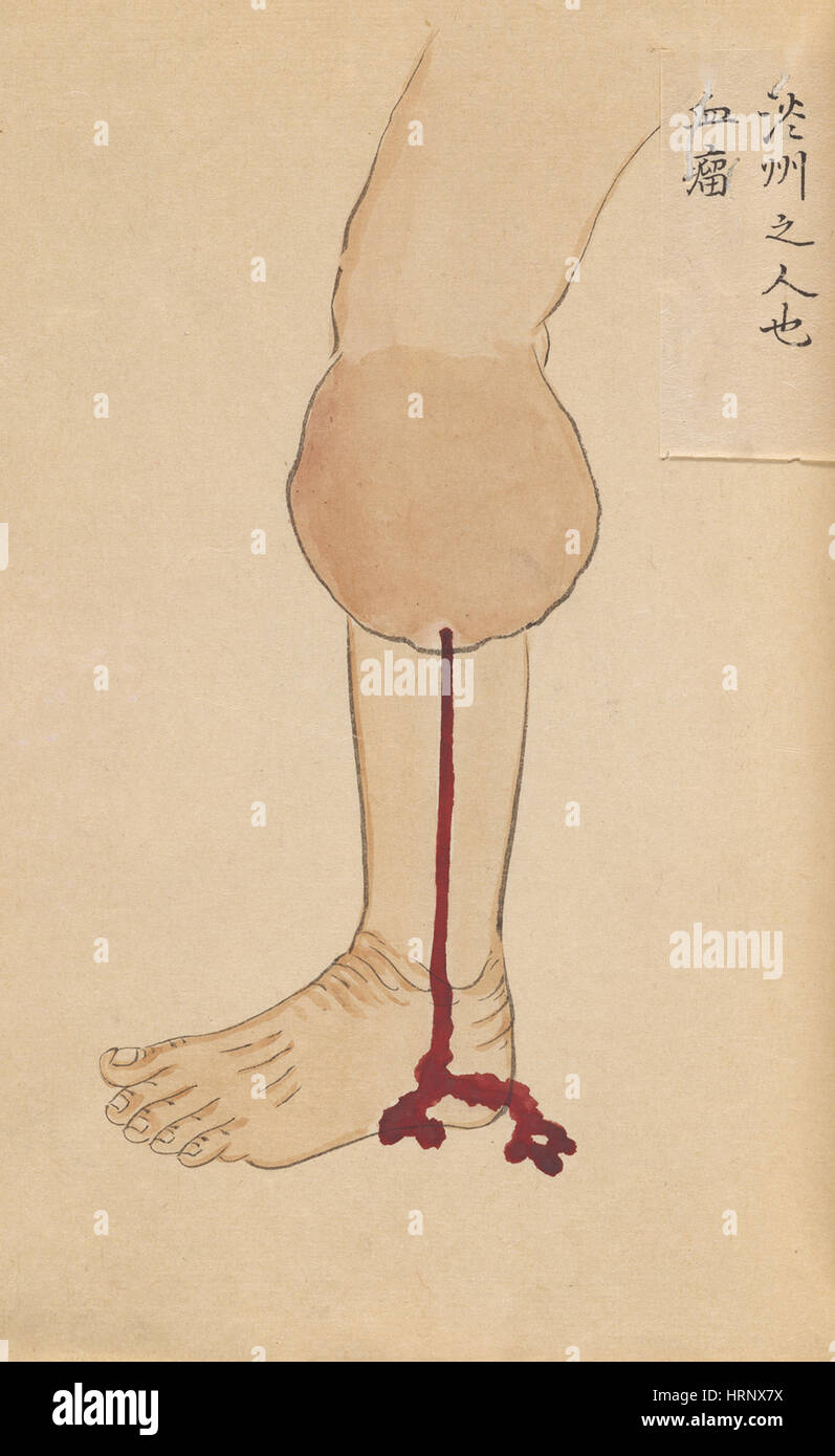 Blut-Tumor, "Chirurgische Casebook" Stockfoto