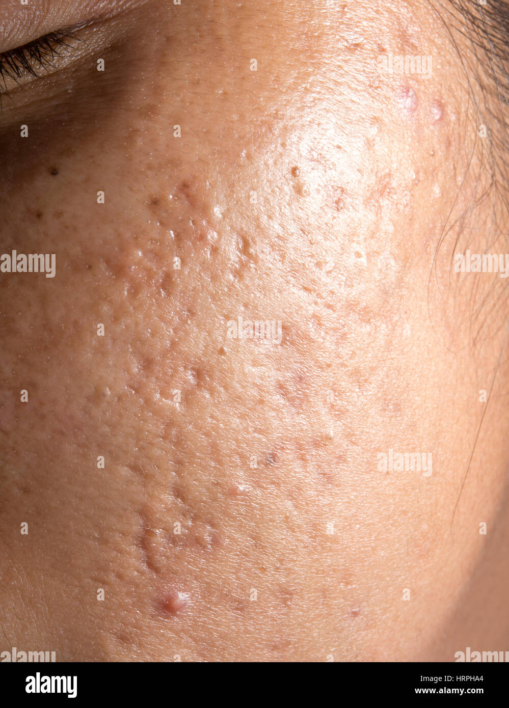 Frauen mit Closeup problematische Haut und Akne-Narben Stockfoto
