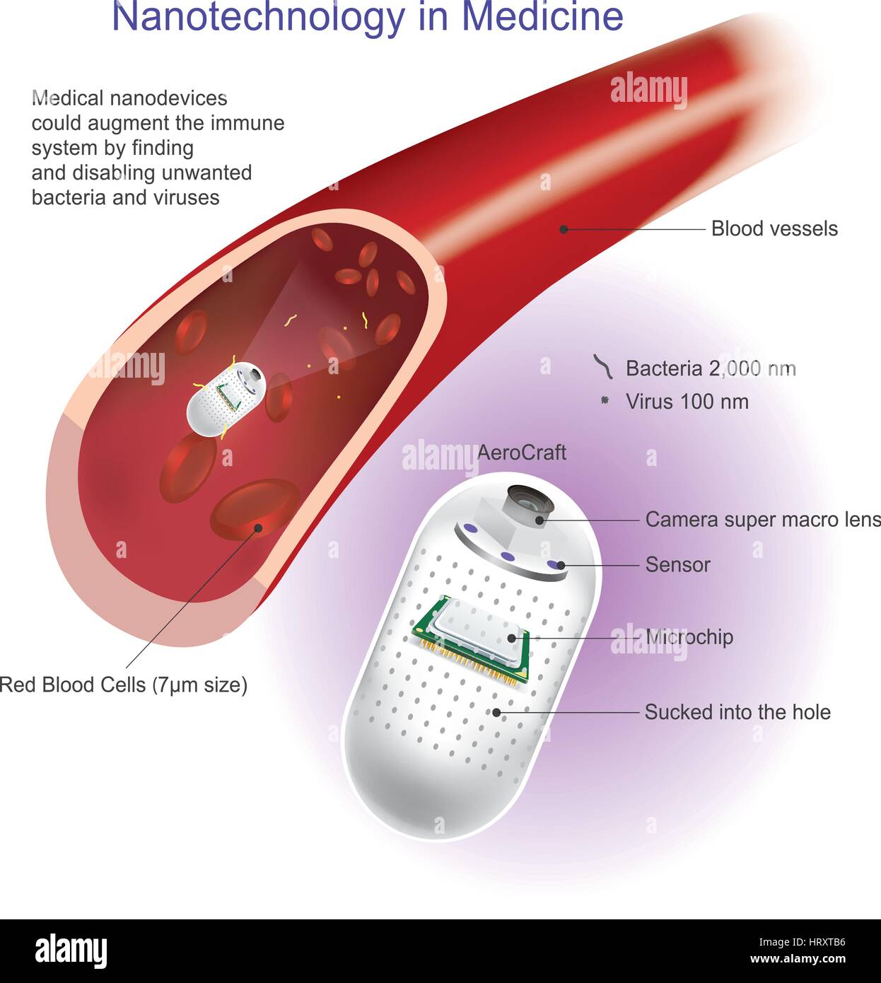 Angioplastie (oder Ballondilatation) ist eine endovaskuläre Verfahren erweitern verengt oder verstopft Arterien oder Venen, in der Regel zur Behandlung von arteriellen ather Stock Vektor