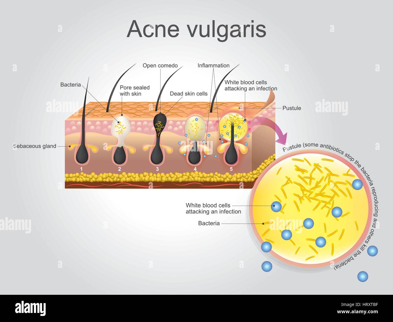 Akne Vulgaris ist eine langfristige Hautkrankheit, die auftritt, wenn Haarfollikel mit abgestorbenen Hautzellen und Öl von der Haut verstopfen. Akne ist Charakter Stock Vektor