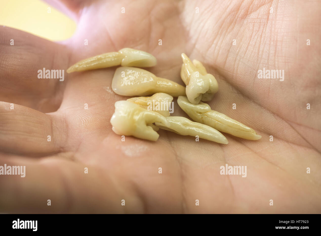 Zahnersatz, Zahnersatz, Prothetik, Hände an die Prothese, falsche Zähne zu arbeiten. Stockfoto