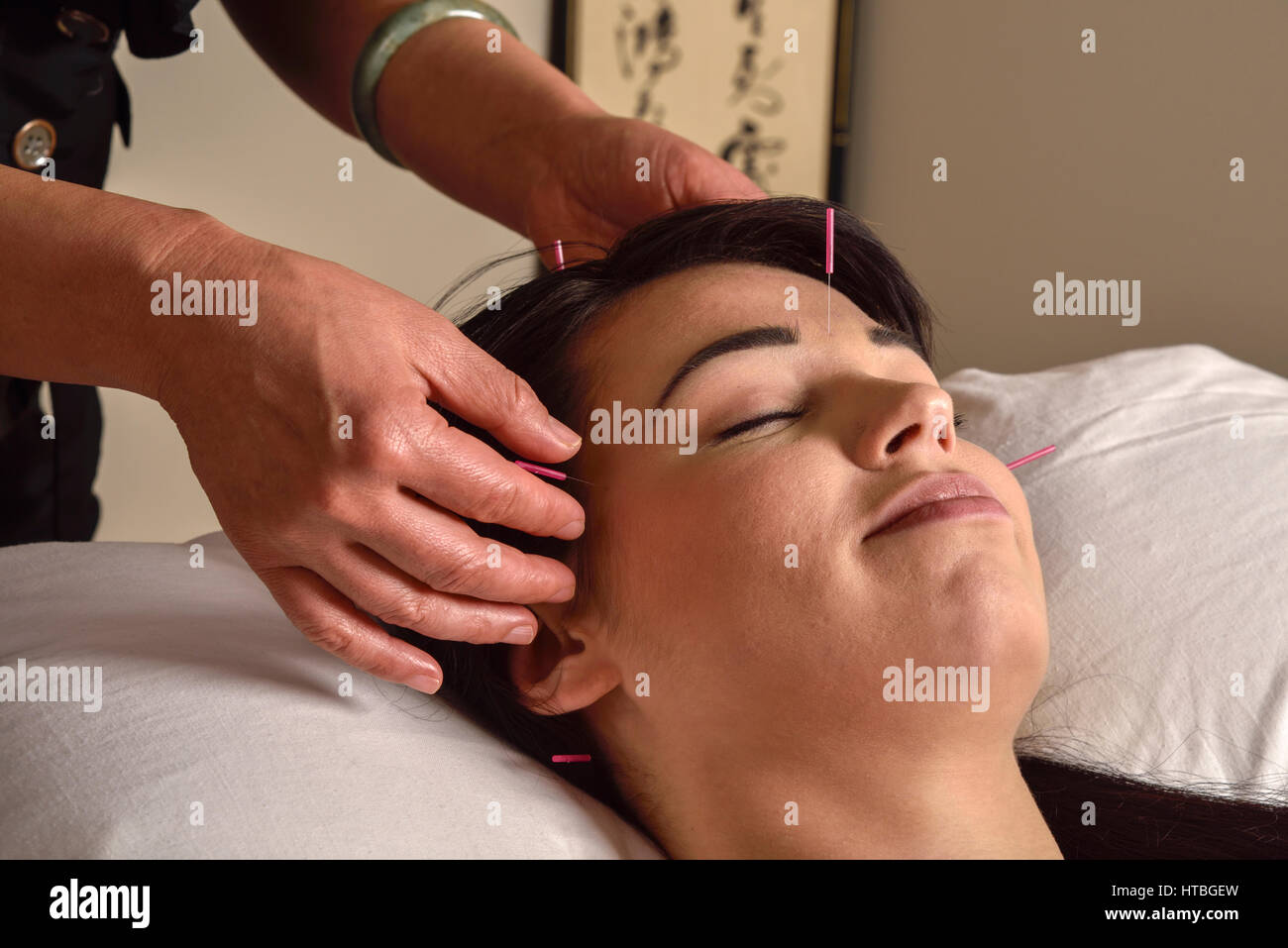 Akupunktur-Behandlung am Kopf und Tempel der jungen Frau eine Modalität der traditionellen chinesischen Medizin Stockfoto