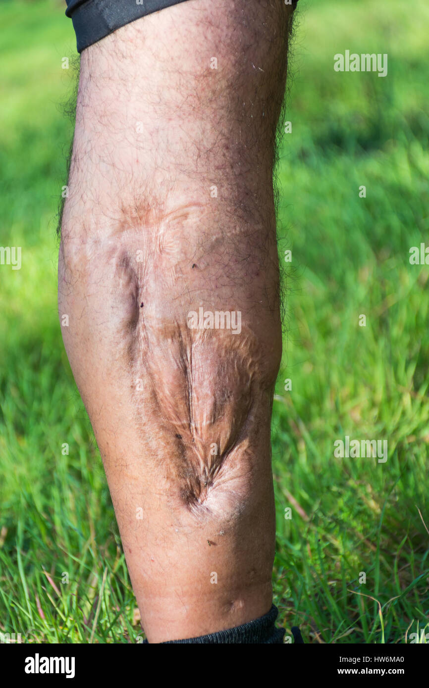 Alte Narbe der Beinverletzung von Auto oder Motorrad Unfall, Tiefengewebe Narbe, haarlose Mann Bein, Wadenverletzung, große Narbe an der rechten Wade. Die Narben als Stockfoto