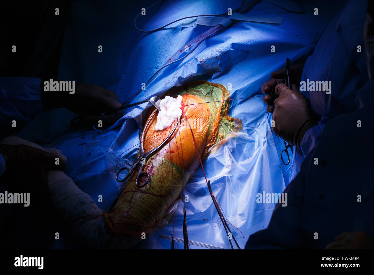 Echte Schulterchirurgie im Gange, mit chirurgischen Tampon in die Wunde und chirurgische Faden auf den Rand. Sportverletzungen, Orthopädie und Gesundheit ca Stockfoto