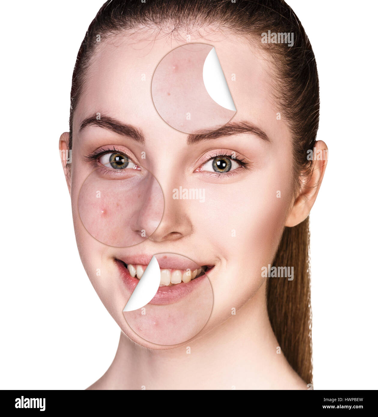 Kreise-Schichten der Haut mit Akne unstick aus gute gesunde Haut der jungen Frau. Stockfoto