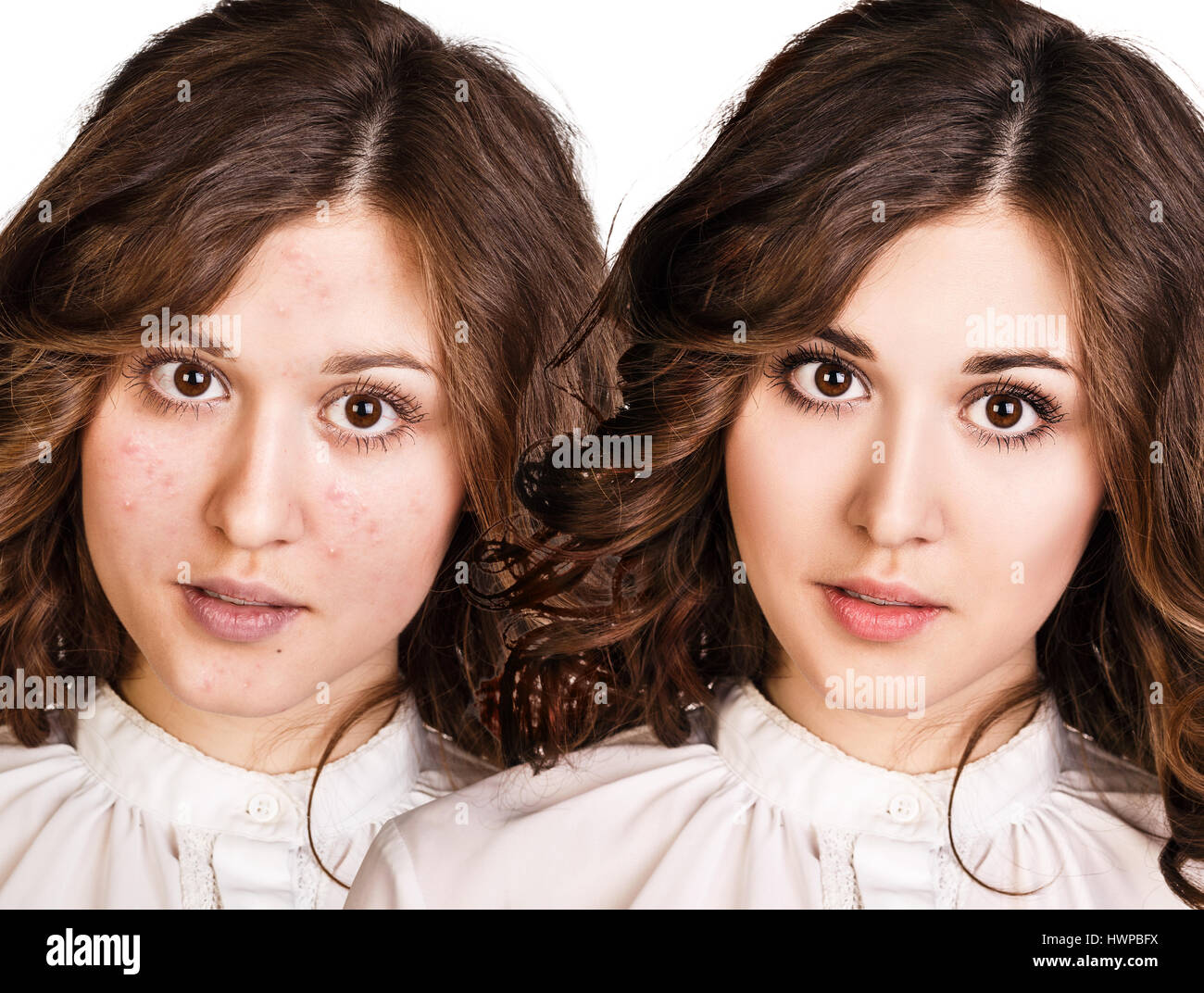 Vergleich-Porträt des jungen Mädchens mit problematischer Haut vor und nach Behandlung und Make-up. Stockfoto