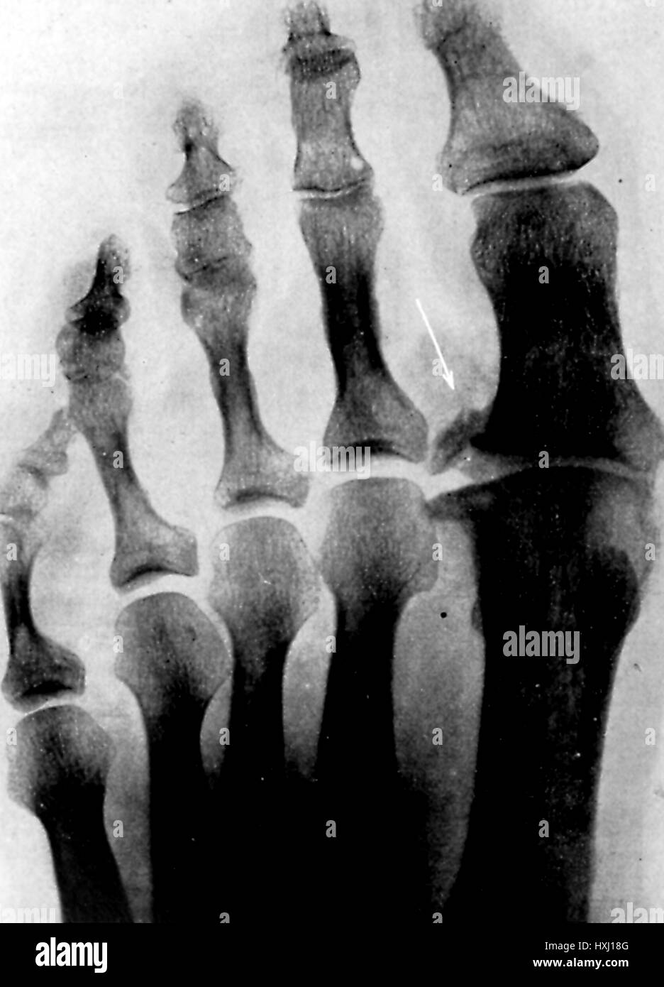 Frühen X-Ray Foto zeigt den Fuß eines Patienten mit Arthrose der Großzehe gemeinsame, 1903. Stockfoto