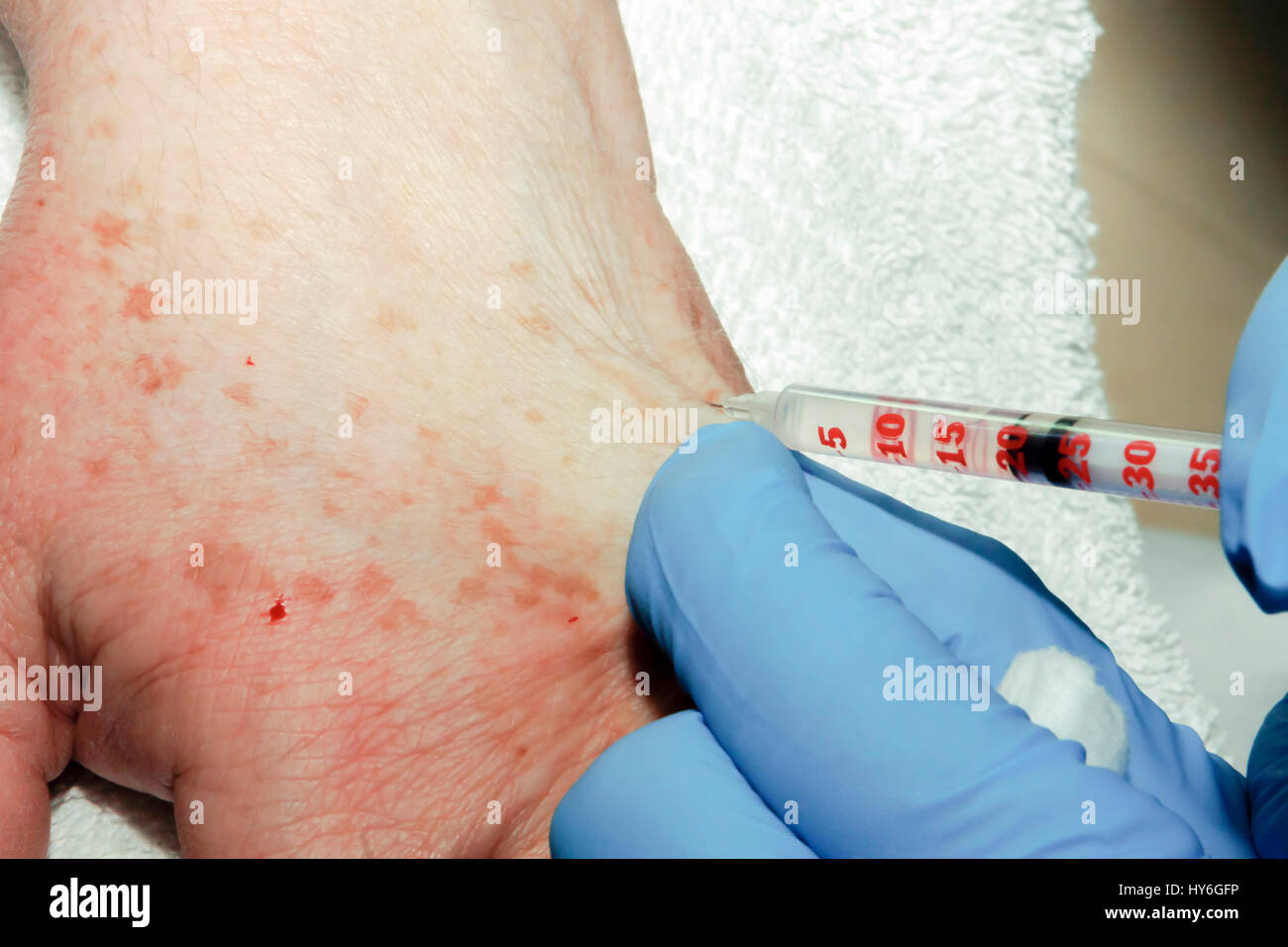 Was Ist Eine Lokale Betäubung www.alamy.de