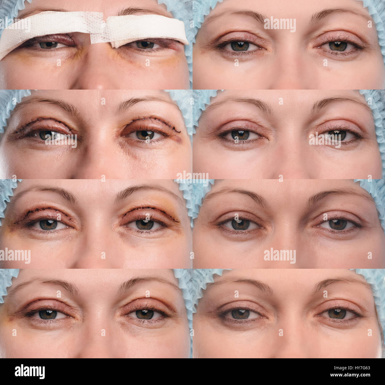 Blepharoplastik des oberen Augenlids Stockfotografie Alamy
