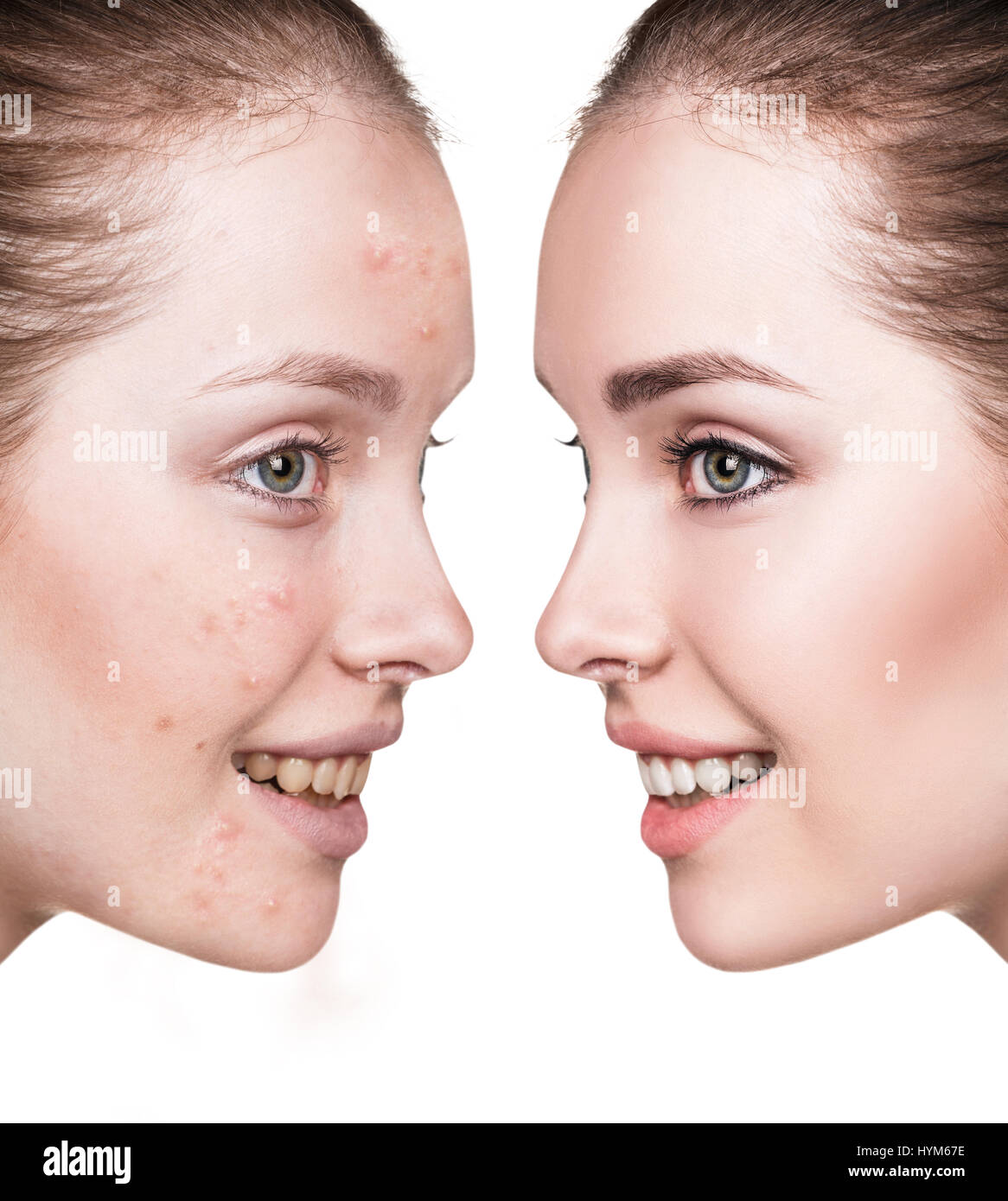 Mädchen mit Akne vor und nach der Behandlung. Stockfoto