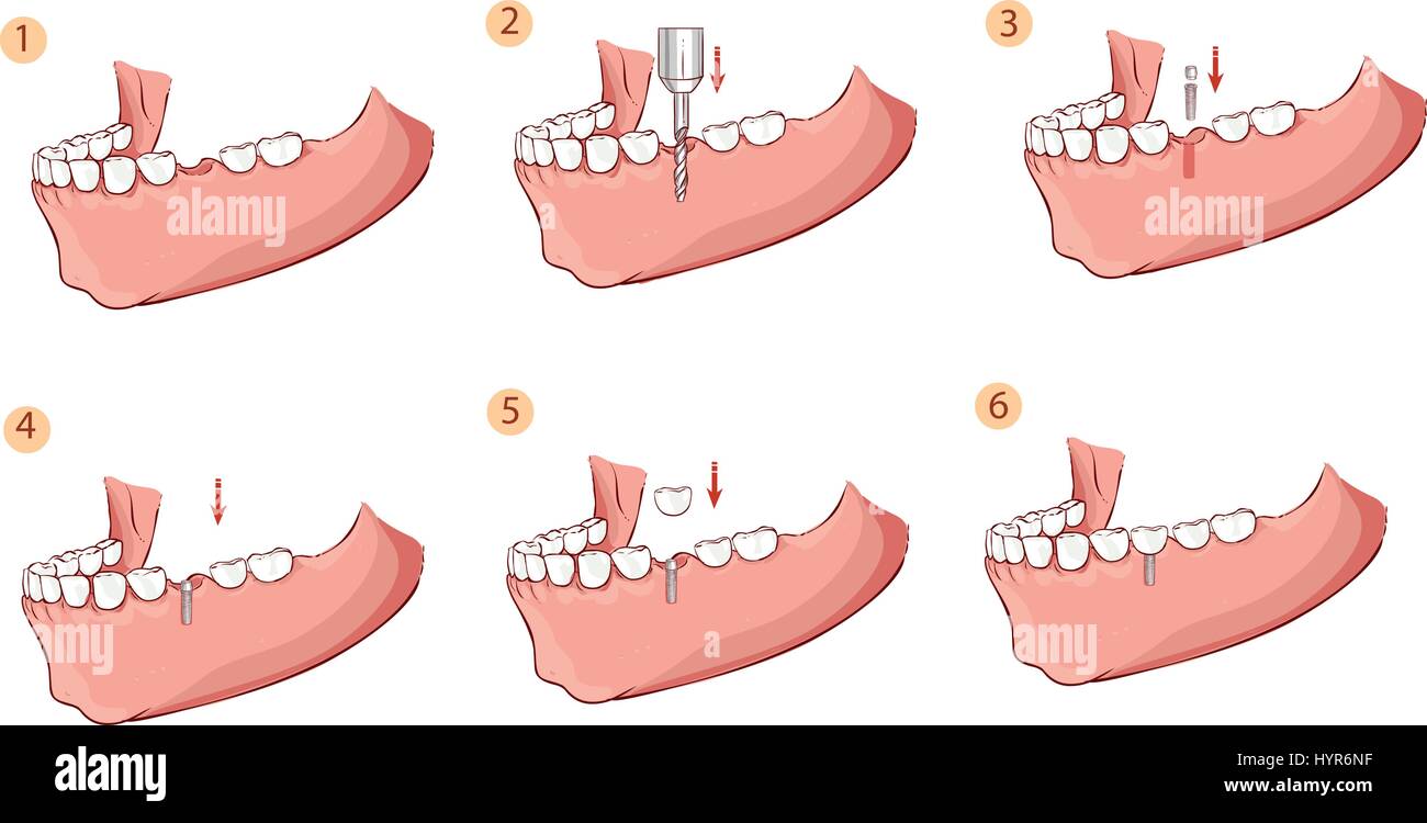 Vector Illustration einer Abbildung eines Zahnimplantats Stock Vektor
