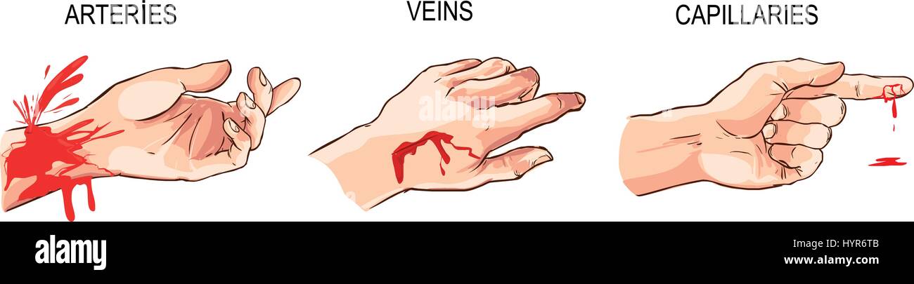 Vector Illustration eines arteriellen und venösen Blutungen Stock Vektor