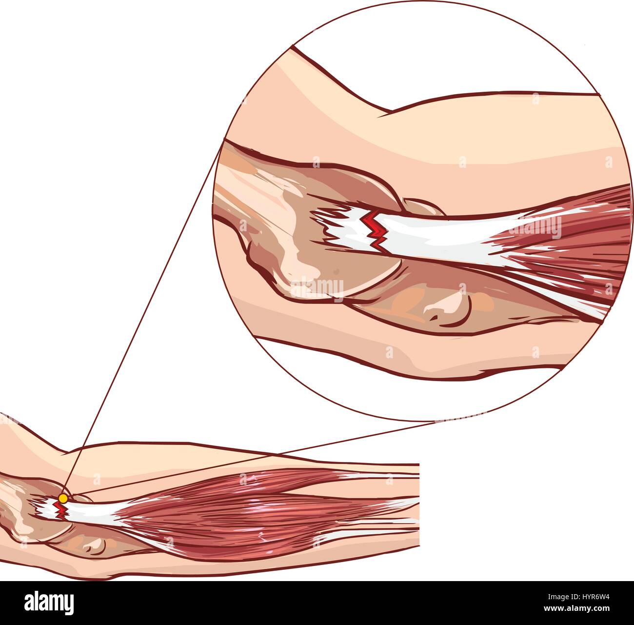 Tennisarm - Riss in der gemeinsamen Beinstrecker Sehne des Arms Stock Vektor