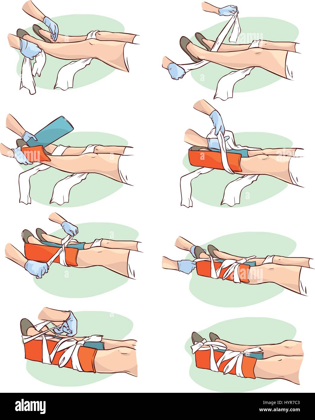 Vector Illustration einer Schienung ein gebrochenes Bein Stock Vektor