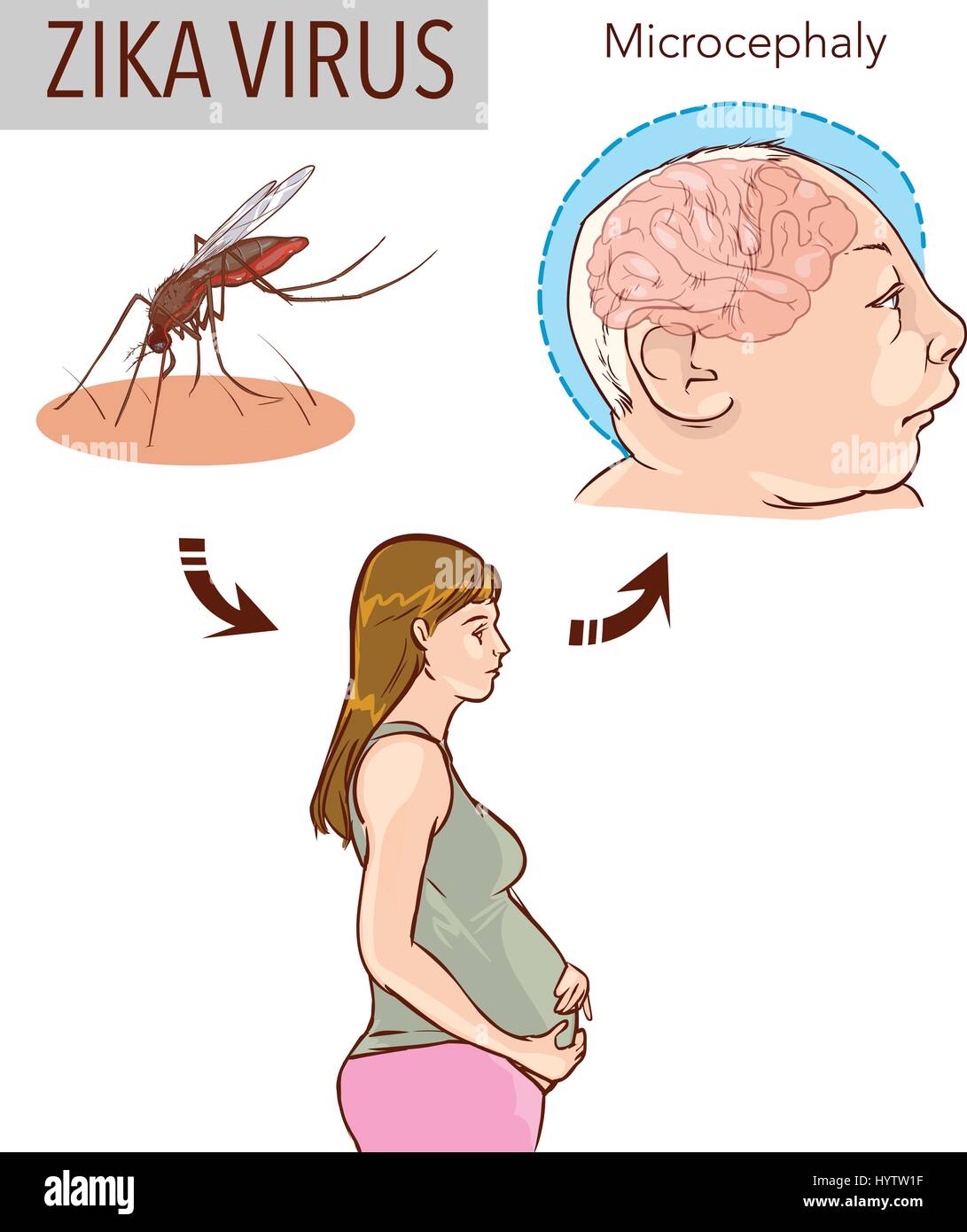 Abbildung: eine Schwangere mit zika Virus und neugeborenes Baby mit mikrozephalie Krankheit Stock Vektor